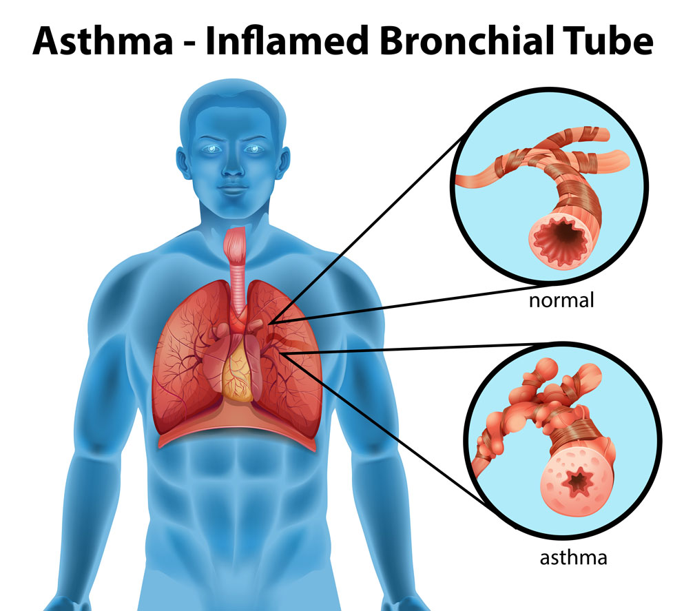 Causes of asthma 
